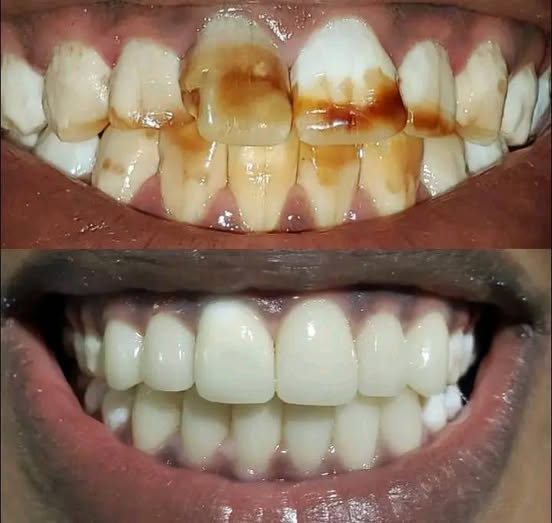 Before and After dental restoration