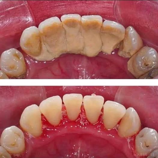 Before and After Scaling treatment