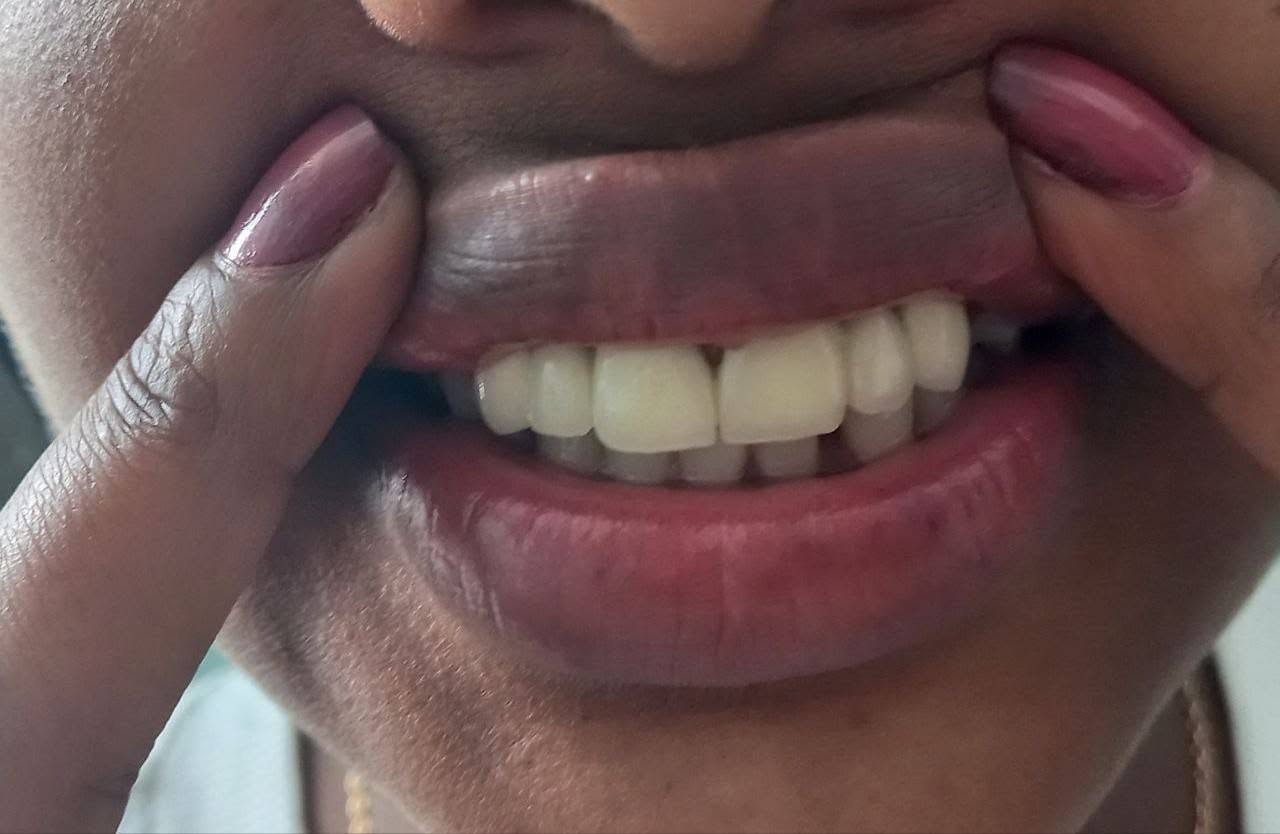 After dental veneer transformation